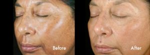 Before and After: Chemical Peel