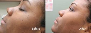 Before and After: Mole Removal