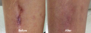 Scar Reduction before and after