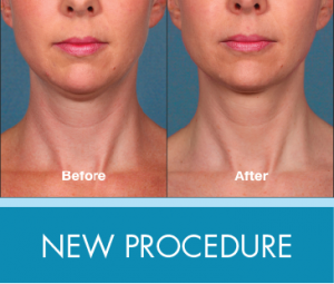 New Procedure: Kybella