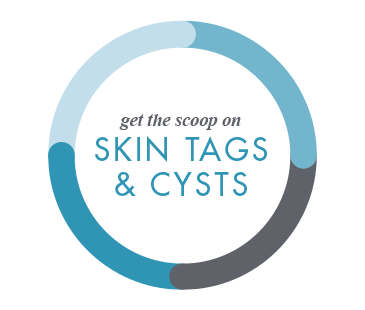 Get the Scoop on Skin Tags and Cysts