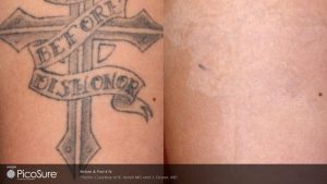 PicoSure® tattoo removal