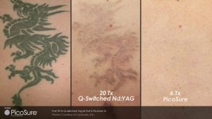 PicoSure® tattoo removal before and after