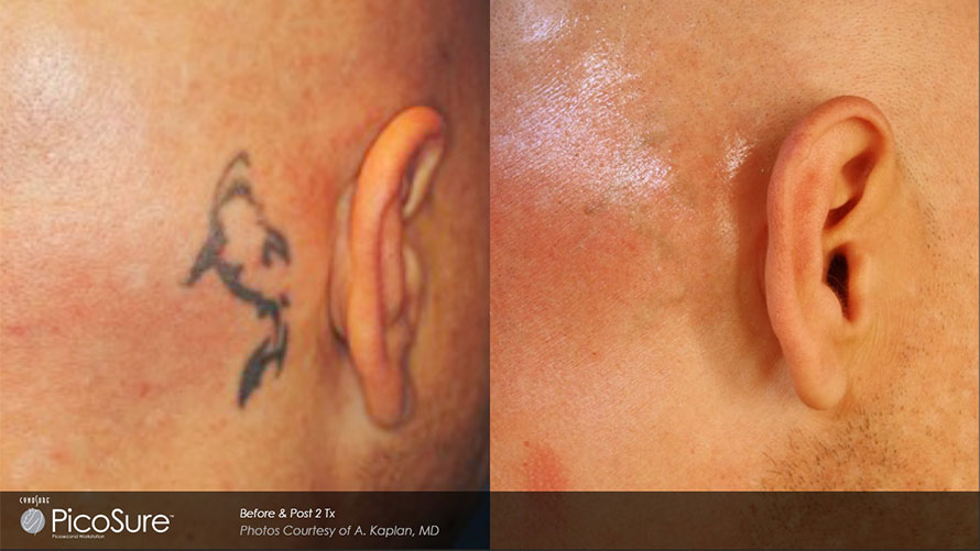 Before and after of laser tattoo removal