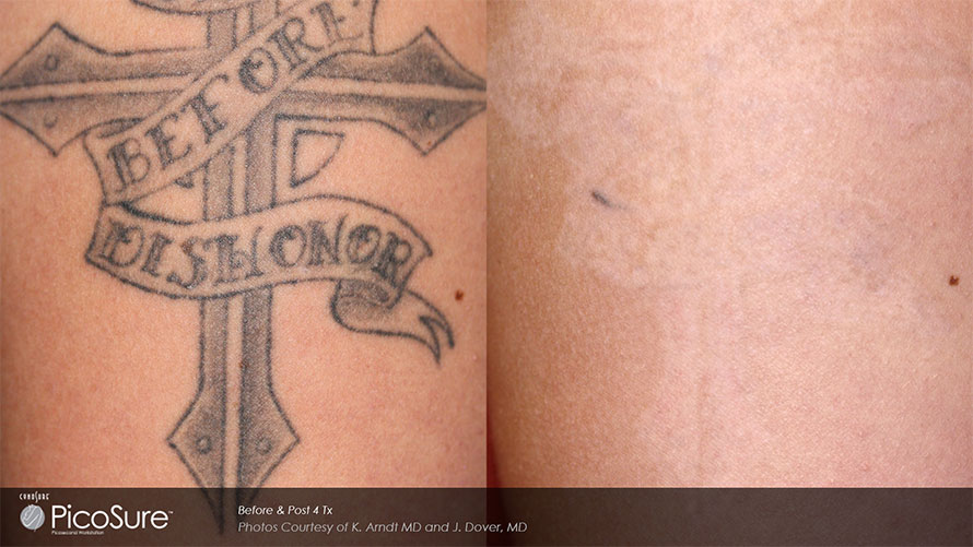 before and after of Laser Tattoo Removal