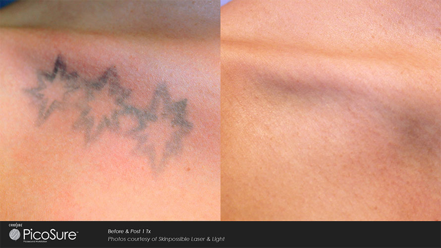 Tattoo Removal | Little Rock, AR | Sunlimited Tanning Salon & Day Spa