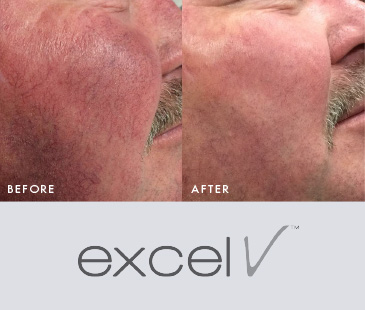 before and after of Excel V Laser