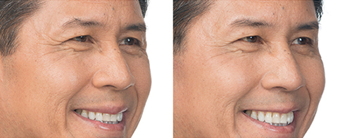 Before and After Laser Tattoo Removal