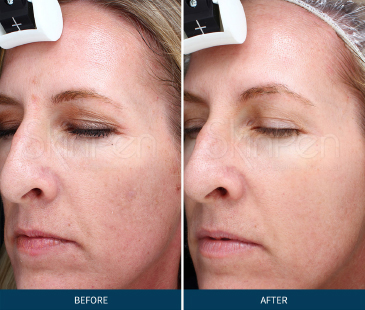 before and after Microneedling Treatment