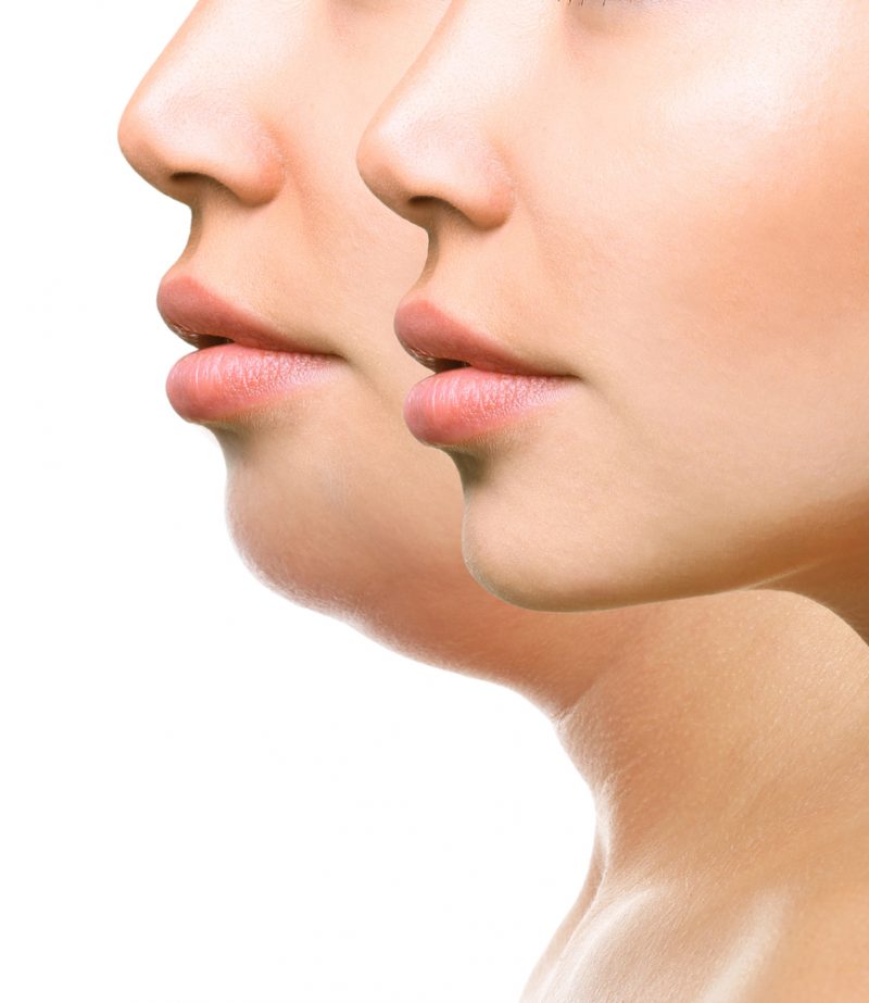 Kybella Solutions in Vestavia AL