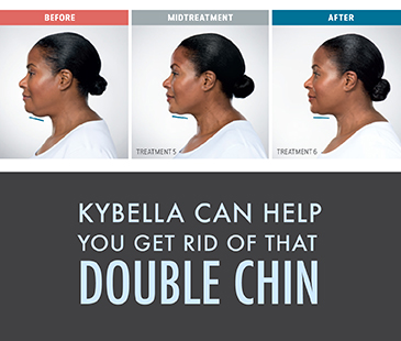 Kybella, Double Chin Treatment