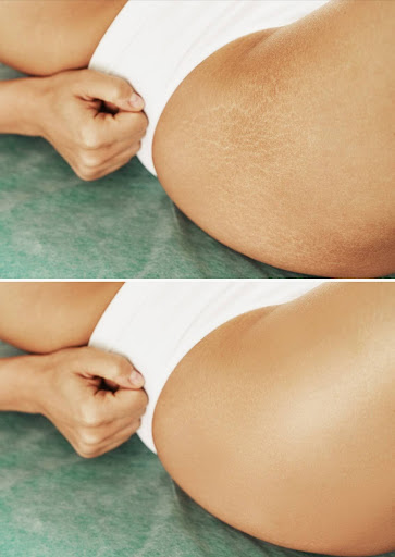 Laser Stretch Mark Reduction Before & After