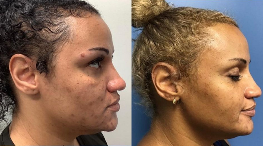 Before-and-after profile of a woman showing reduced acne and improved skin texture after treatment.