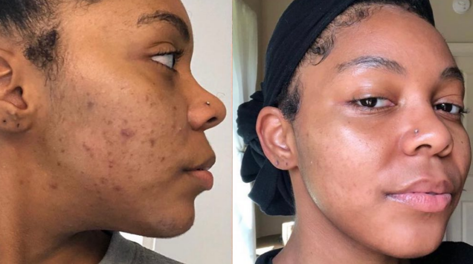 Before-and-after of a patient's acne: left with breakouts and scarring, right with smoother, clearer skin.